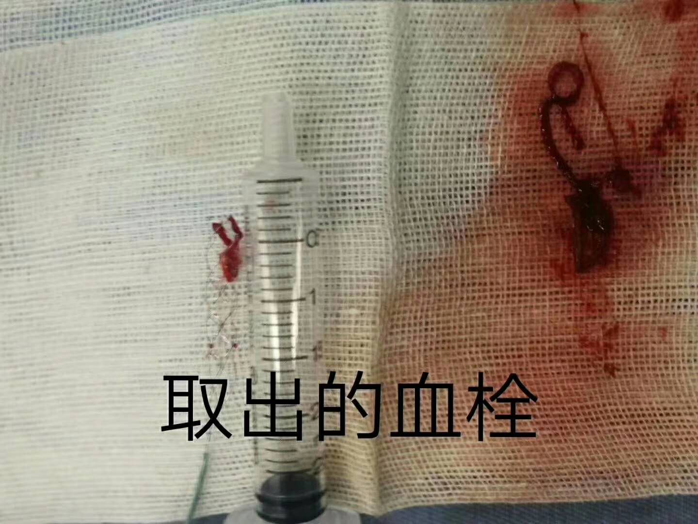 Ժֳɹ(sh)ʩ˨ȡ˨g(sh)Ȳ